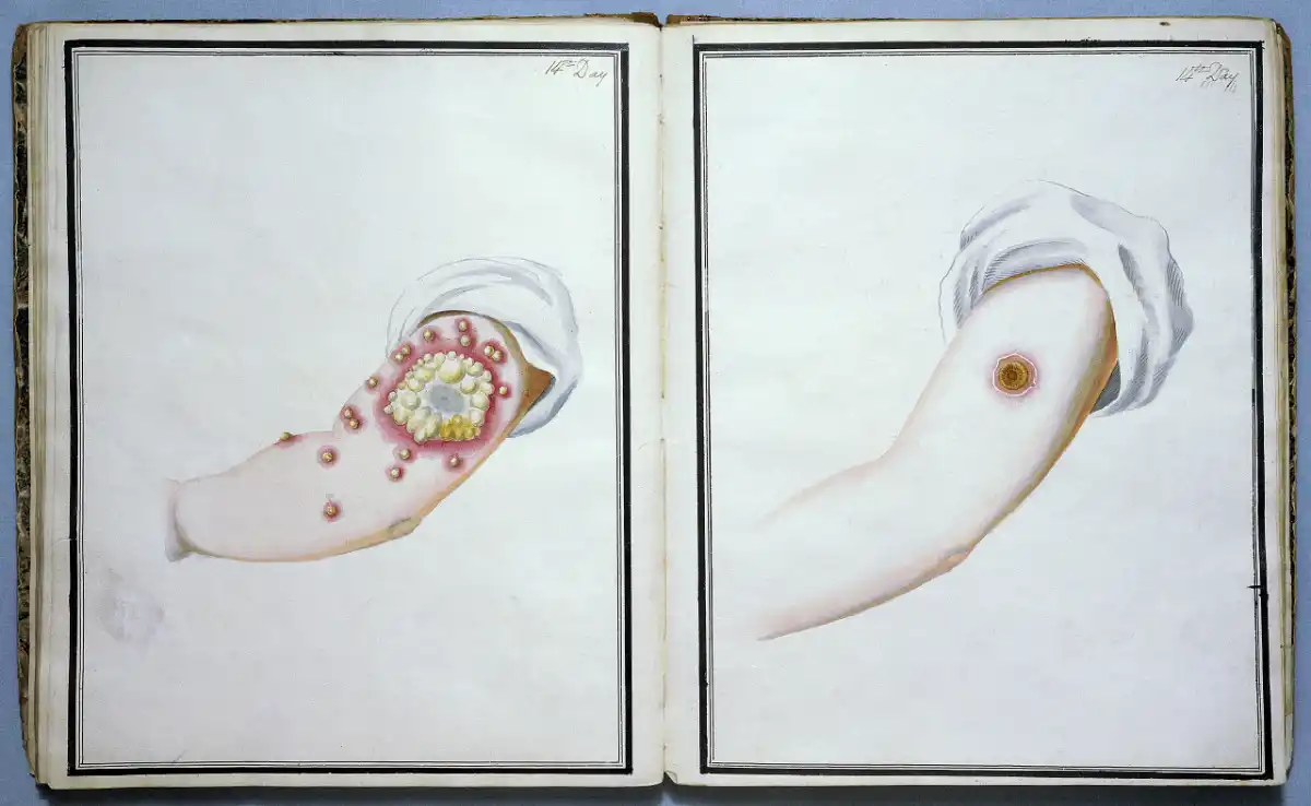 Illustrations of smallpox infections with variolation versus with vaccine