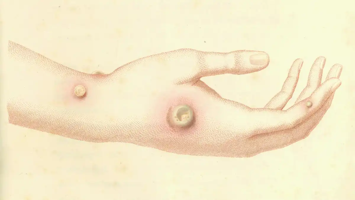 Illustration of cowpox sores
